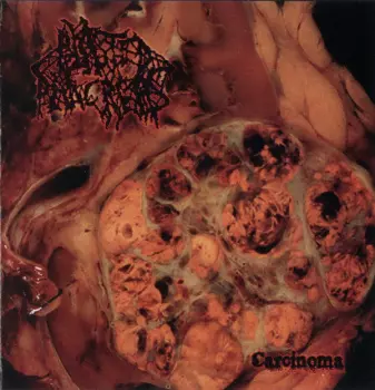 Blasted Pancreas: Carcinoma
